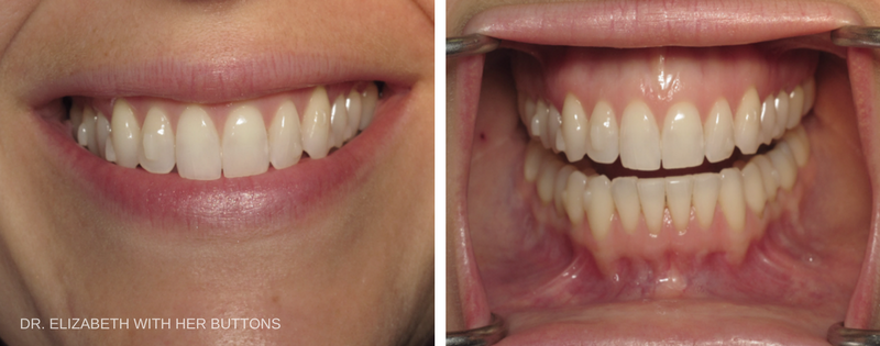 Randi and Dr. Elizabeth's Invisalign® Success Story - Eggert Family  Dentistry