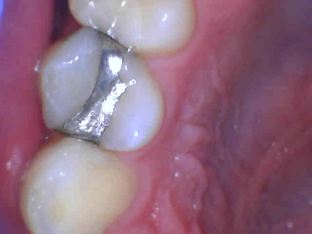 When should a tooth filling be replaced?