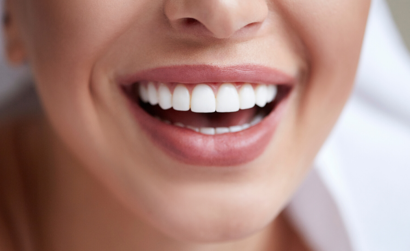 I Want to Whiten My Teeth Professionally: What Are My Options?