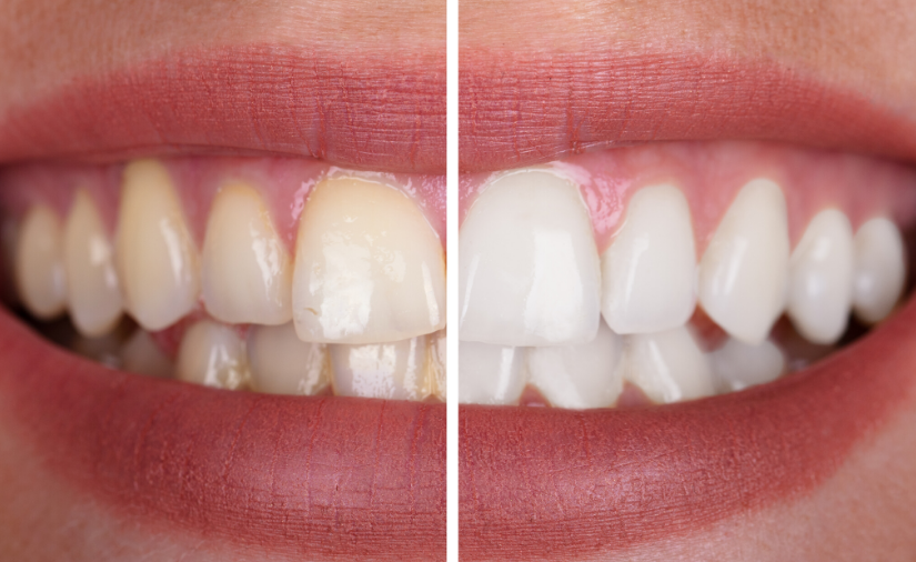 Tooth Discoloration: Causes and Prevention
