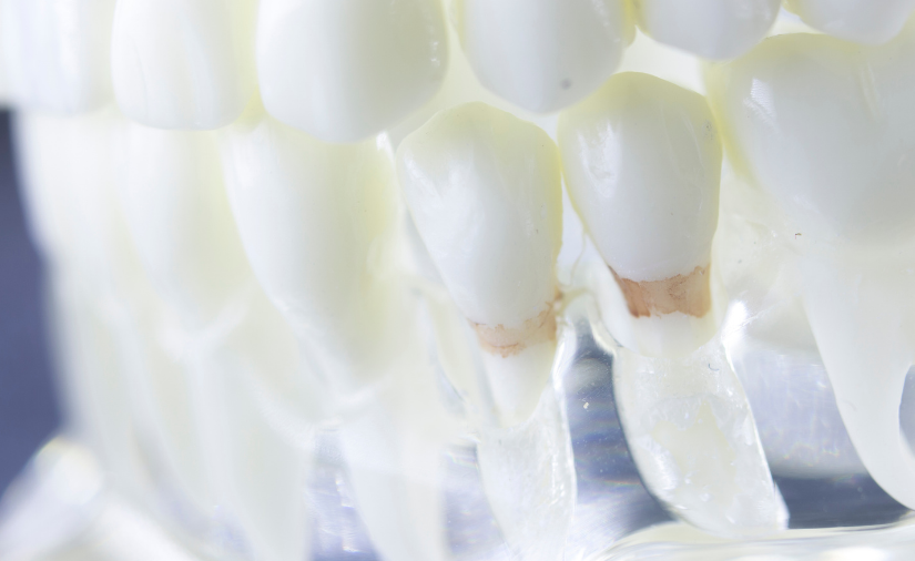 How Much Do You Know About Plaque, Your Teeth’s Biggest Enemy?