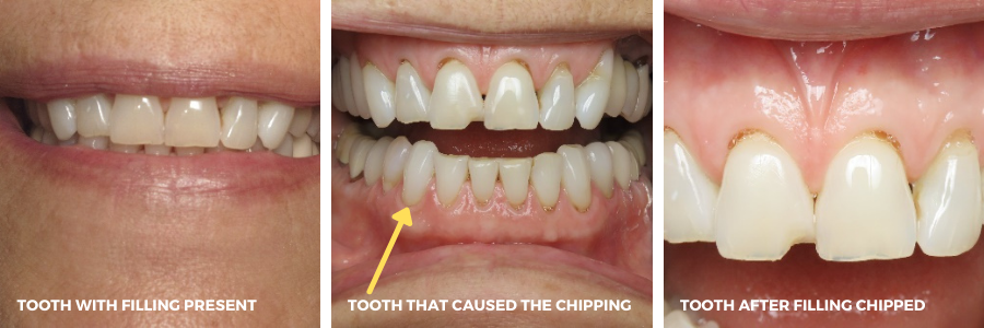 Chipped front tooth filling - Easy Solution! - Bauer Smiles