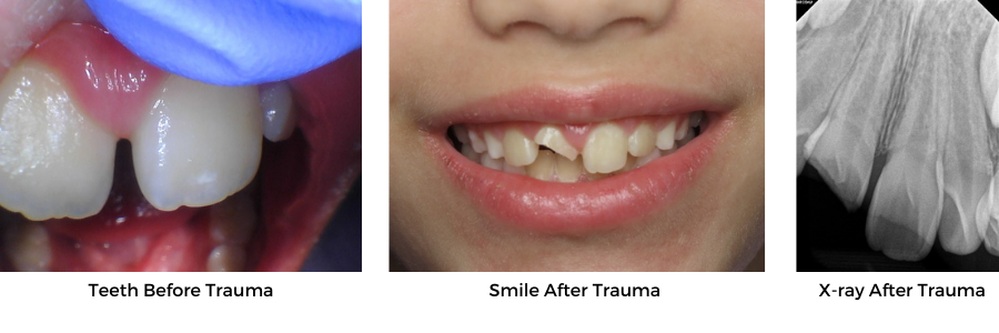 Damaged Teeth?  Fractured Tooth Repair in Fairfield, CT