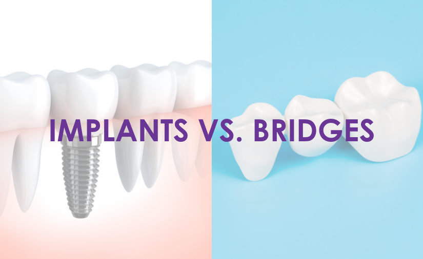 What Exactly Are Implants, and Should You Consider Them? Comparing Implants and Bridges