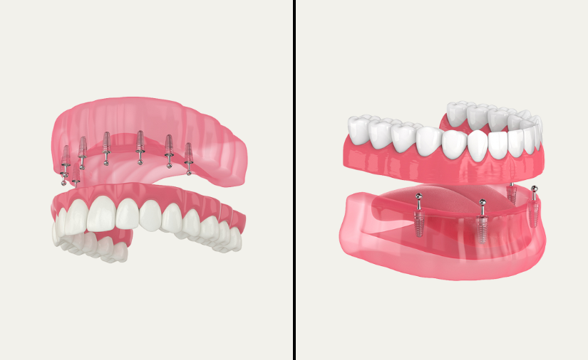 Implant Supported Dentures vs. the All-on-4 Technique: Which is Right for You?