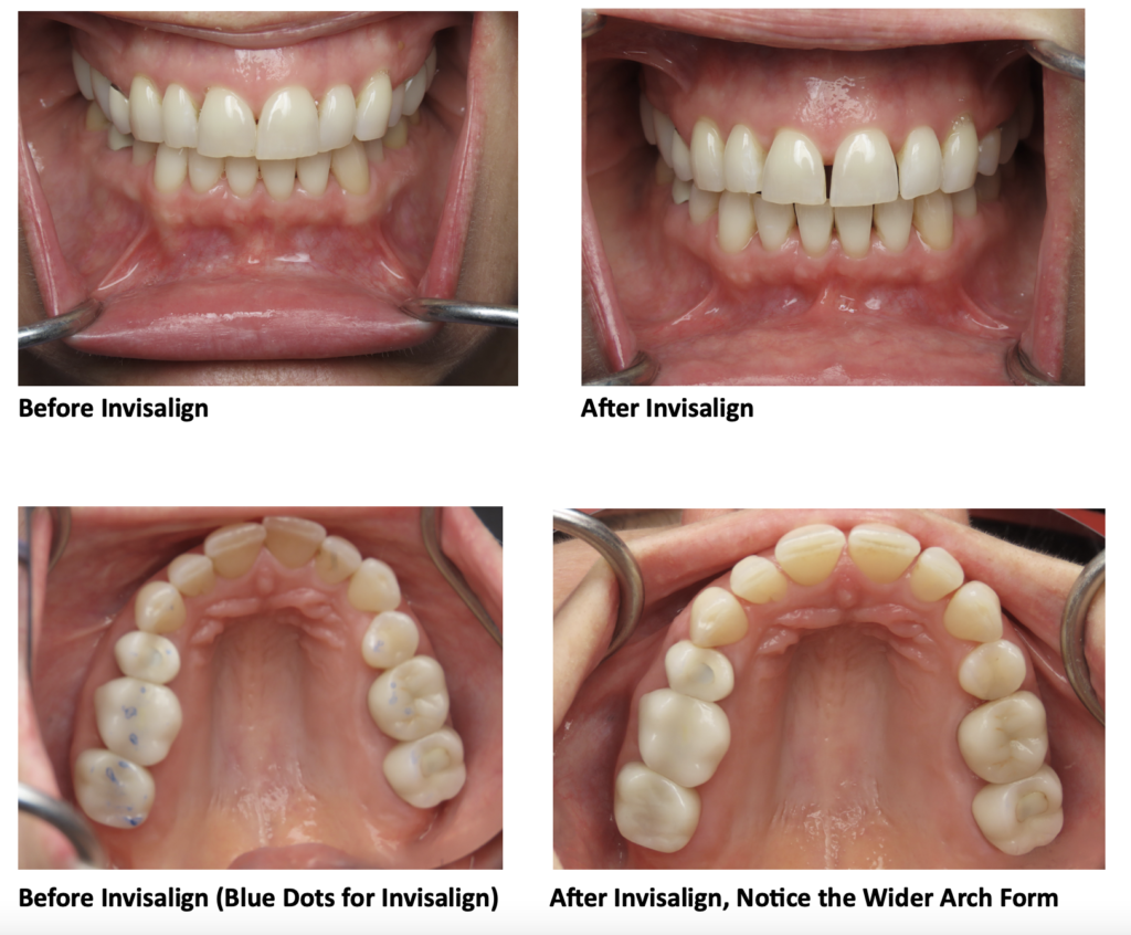 Invisalign® Archives - Eggert Family Dentistry Blog