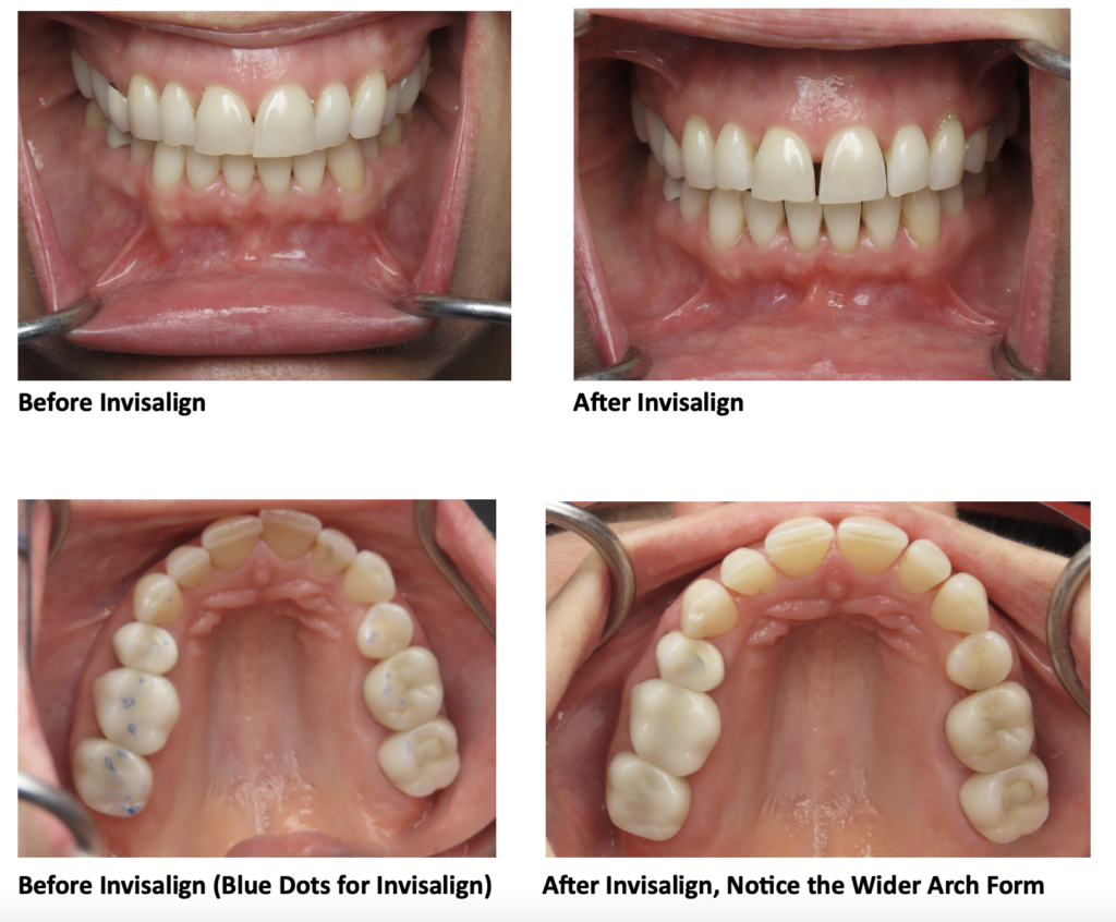 invisalign before and after spacing