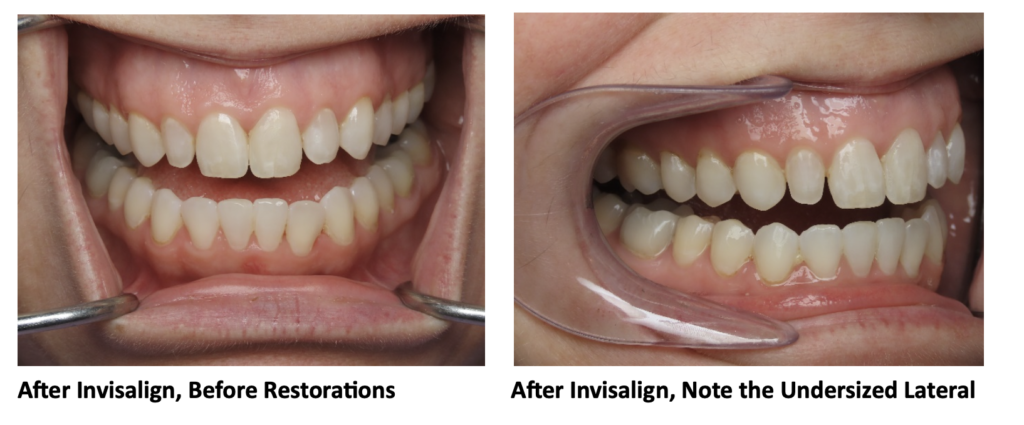 After Invisalign, Before Restorations 