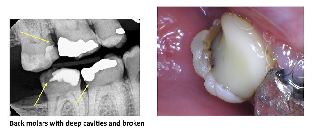 Back molars with deep cavities and broken