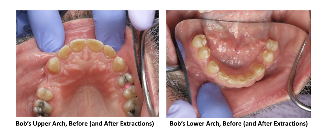 Bob’s Upper and Lower Arch