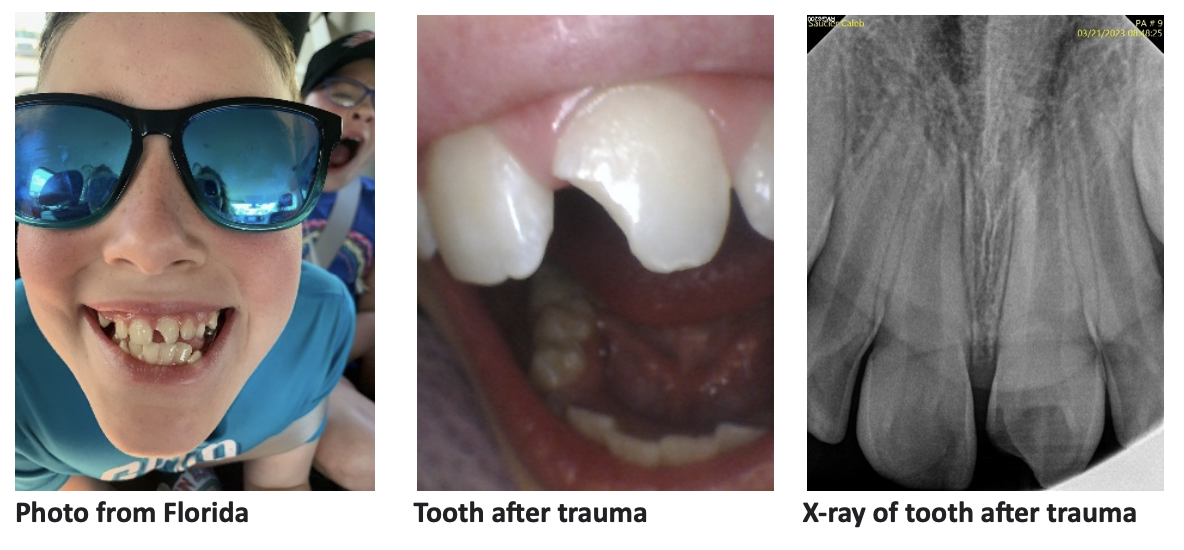 Calebs tooth before