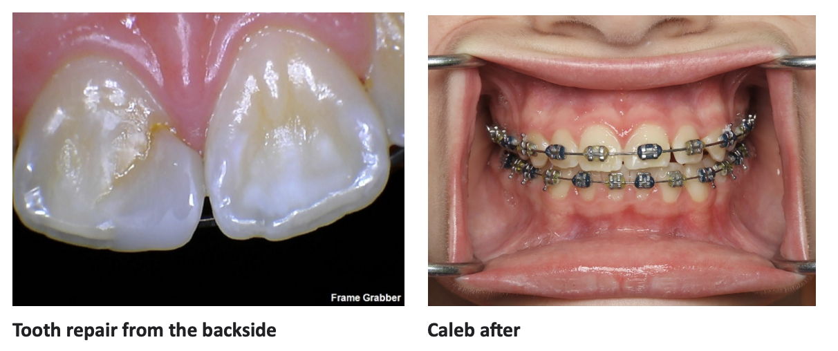 Caleb in Braces