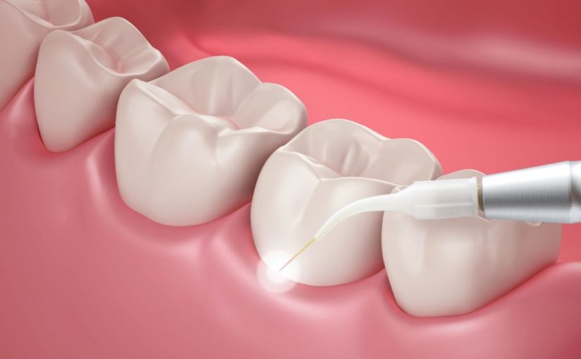 Laser Dentistry – An Innovative Solution