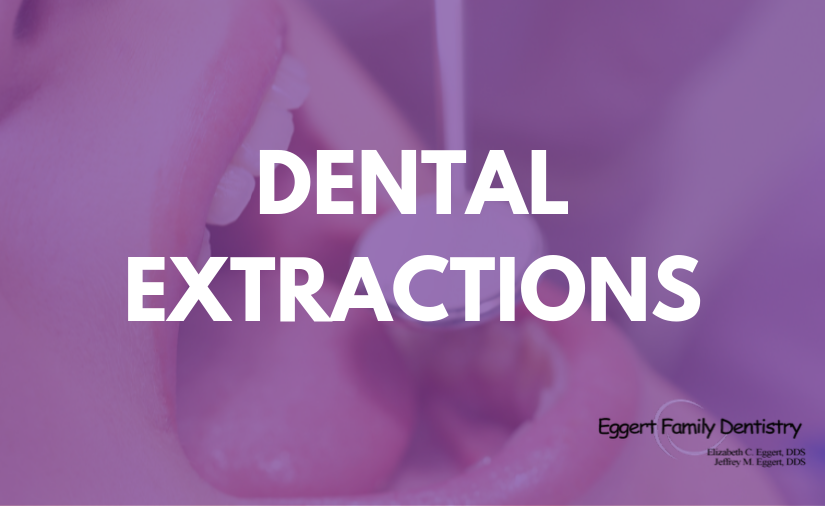 All About Dental Extractions