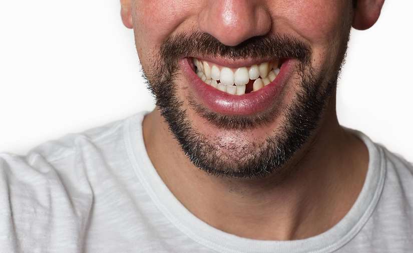 Why It’s Important to Replace Missing Teeth