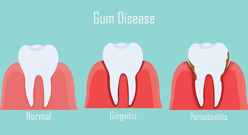 Gingivitis and Periodontitis: What’s the Difference?