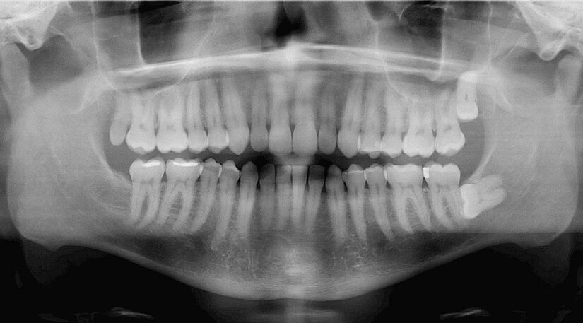 Do You Think Your Wisdom Teeth Should Be Removed? Watch for These Common Signs