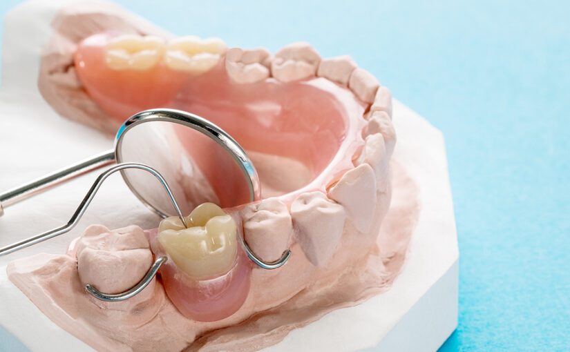 All About Partial Dentures: What Can You Expect When You Get Them?