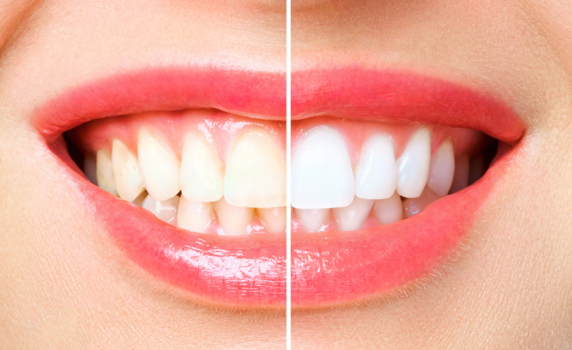 3 Teeth Whitening Treatments: How to Get A Snow-White Smile for the Holidays