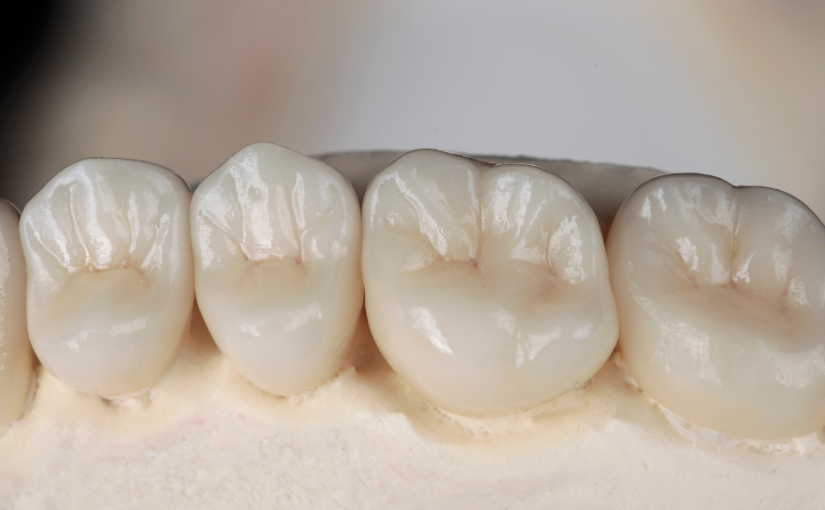 Crown Longevity: How to Make Your Dental Crown Investment Last