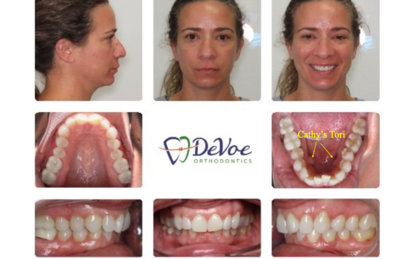 My Journey with Adult Orthodontics and Porcelain Veneers – Cathy’s Story
