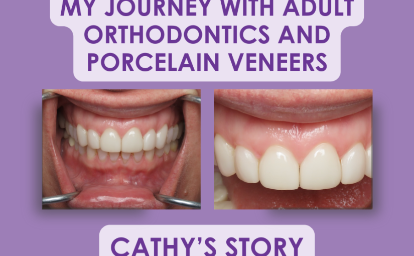 My Journey with Adult Orthodontics and Porcelain Veneers – Cathy’s Story