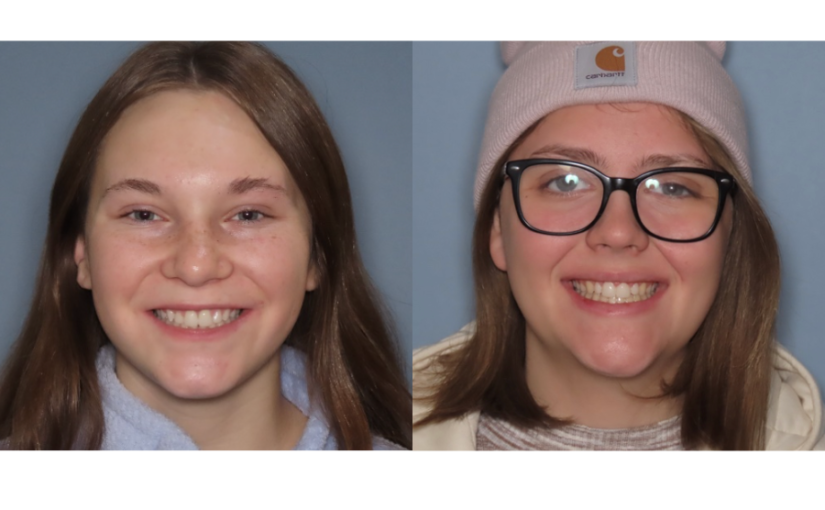 “Say Cheese!” – Composite Bonding and Veneers – Grace and Abigail’s Stories