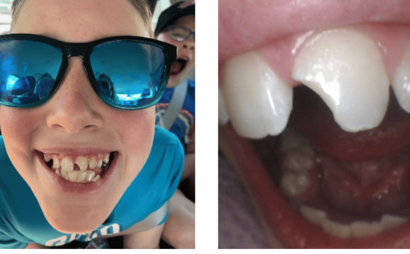 My Spring (Tooth) Break!  Fixing a Fractured Front Tooth – Caleb’s Story!